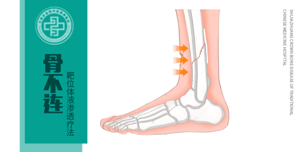 骨不连是什么，骨折手术后肿胀多久能消图1